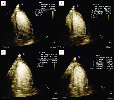 lvef tte transthoracic echo.